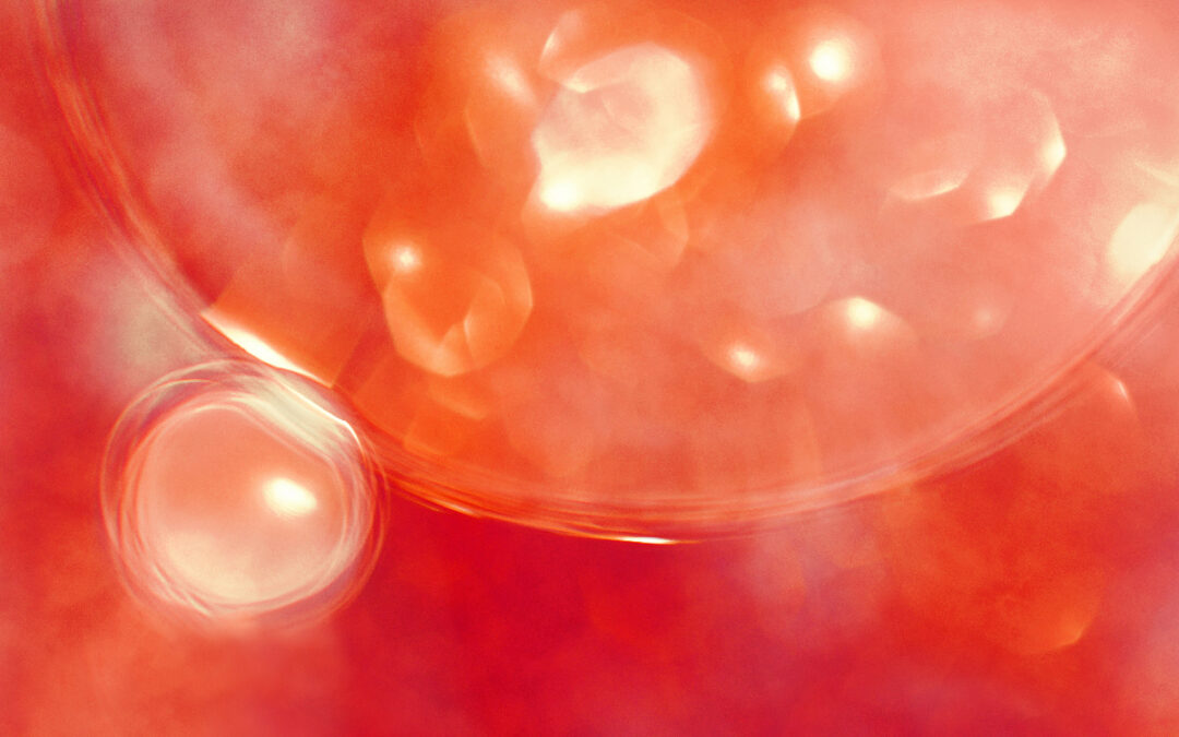 Intravenous Phosphatidylcholine in Severe Refractory Mast Cell Activation Syndrome: A Case Report