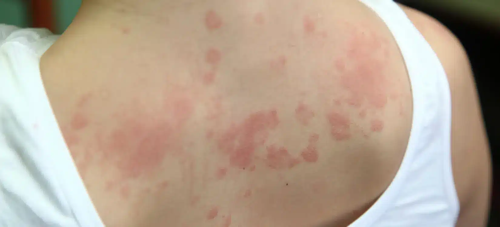 Red raised hives and urticaria welts covering a woman's back, showing an allergic skin reaction with inflamed pink patches.
